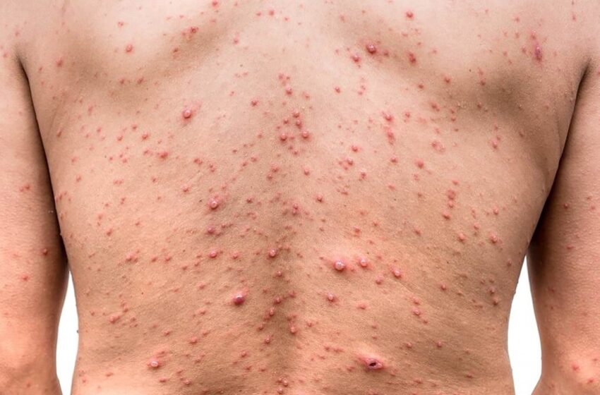  Reportan 31 casos de viruela del mono